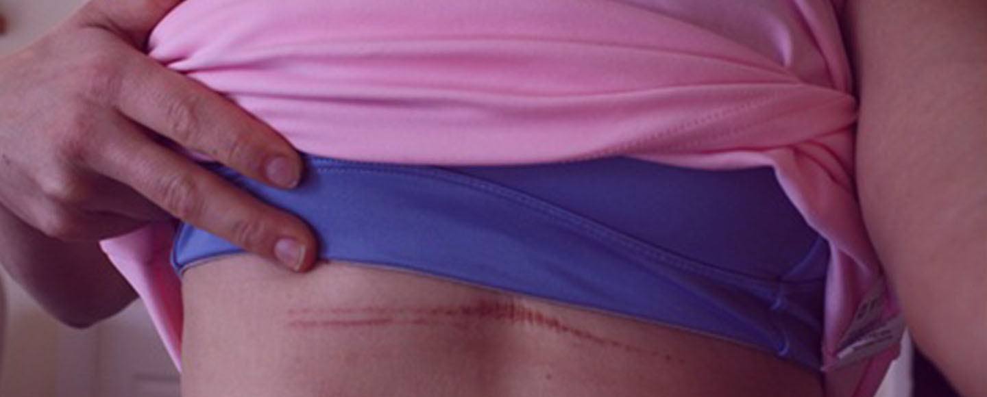 6 Easy Ways of Preventing Bra Chafing Under Arm (Skin Irritation )